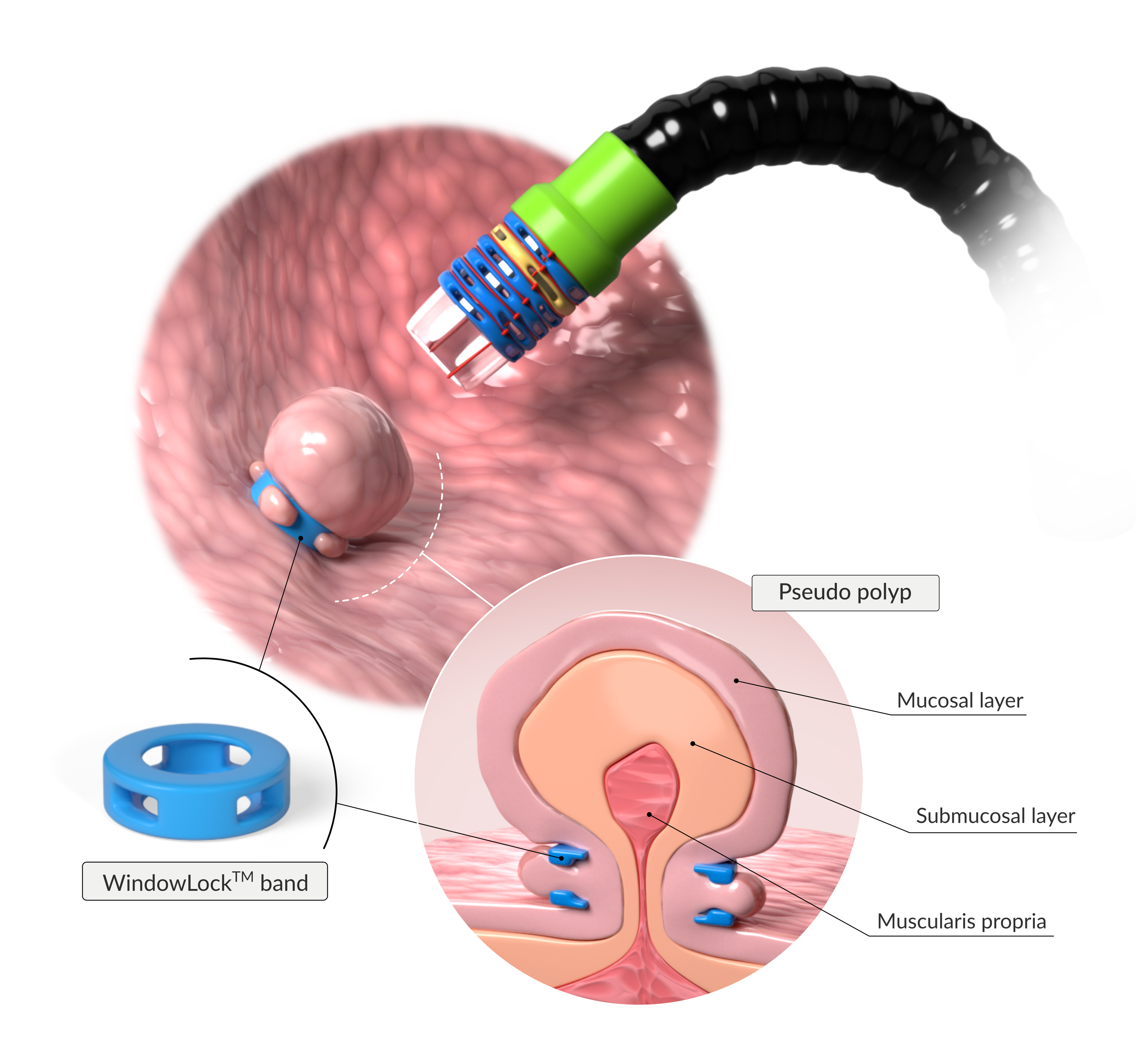 Endolastic™ Banding Illustration